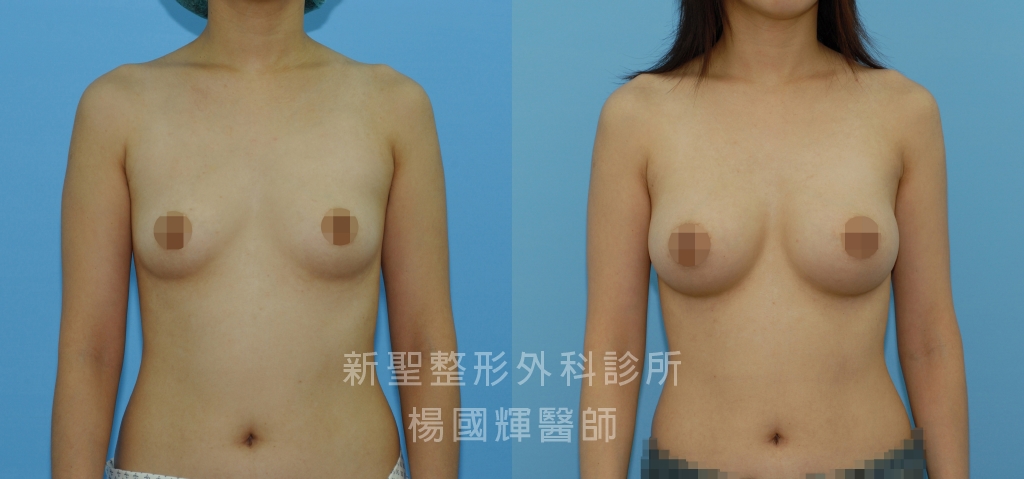 Motiva魔滴隆乳豐胸-下胸圍72公分-乳距17公分-胸大肌下植入左-右各300cc義乳
