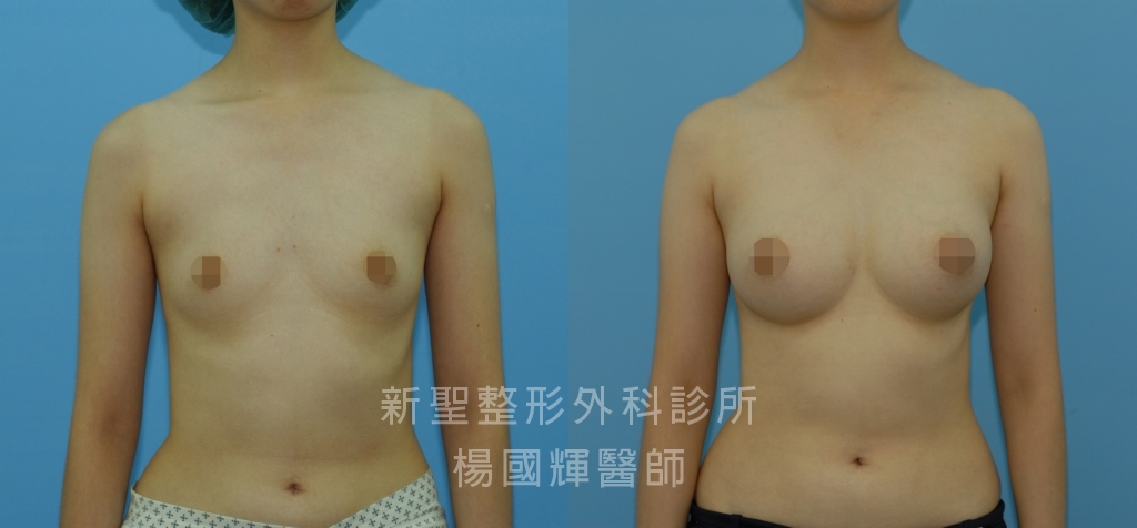 隆乳推薦-身高163公分-下胸圍65公分-乳距16公分-胸大肌下植入左275cc-右300cc義乳